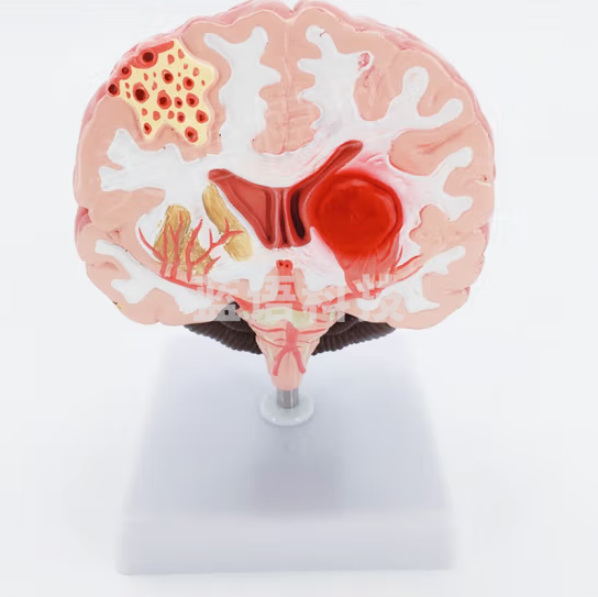 蓝蝶 人体脑解剖 脑病理疾病 脑病理 构造 脑血管 病变脑模型 脑中风模型