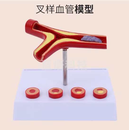 蓝蝶 人体血管模型动脉血管阻塞变化演示教学模型器官解剖结构层次模型 叉样血管