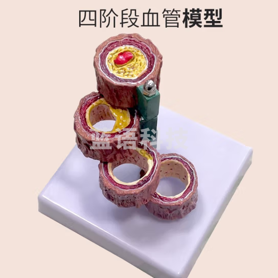 蓝蝶 人体血管模型动脉血管阻塞变化演示教学模型器官解剖结构层次模型 四节血管
