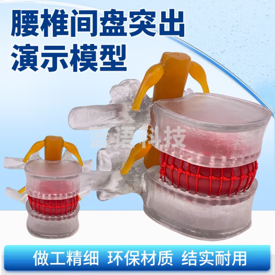 蓝蝶 人体脊柱 腰椎放大 脊椎骨病理演示模型 腰椎间盘演示突出模型 腰椎间盘彭出（透明款）